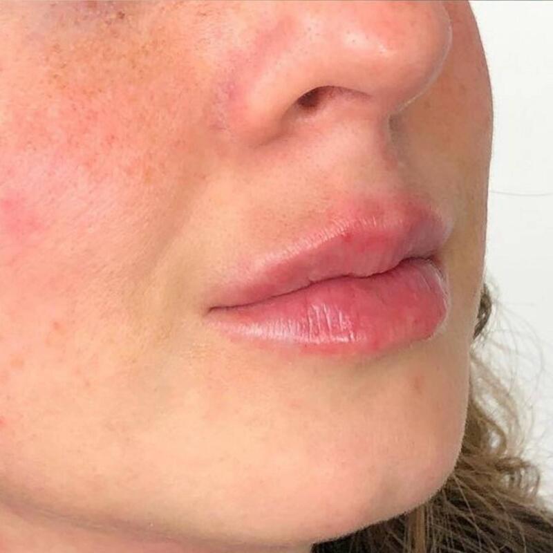 Lips Before & After Image