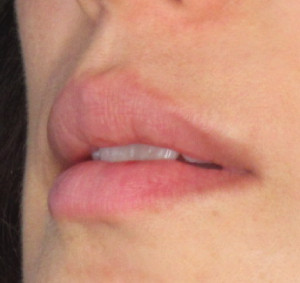 Lips Before & After Image