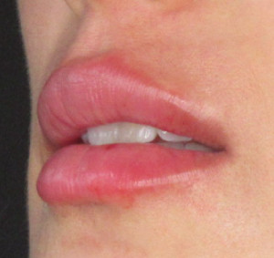 Lips Before & After Image