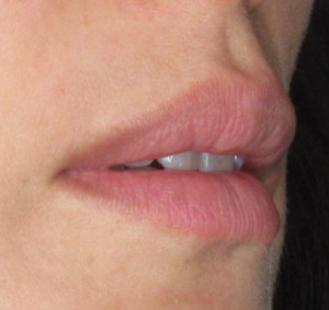 Lips Before & After Image