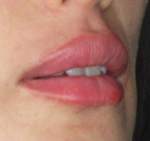 Lips Before & After Image