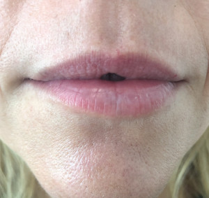 Lips Before & After Image