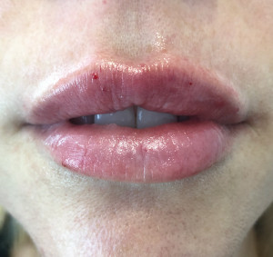 Lips Before & After Image