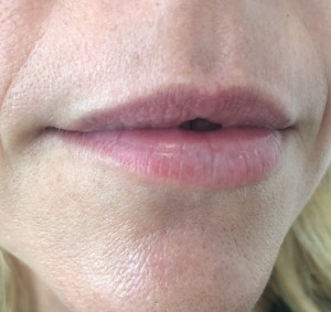 Lips Before & After Image