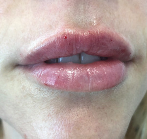 Lips Before & After Image