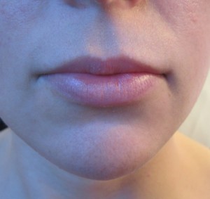 Lips Before & After Image