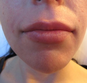 Lips Before & After Image