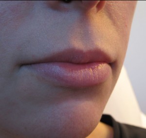 Lips Before & After Image