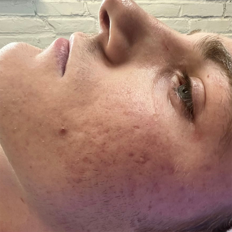 Microneedling Before & After Image