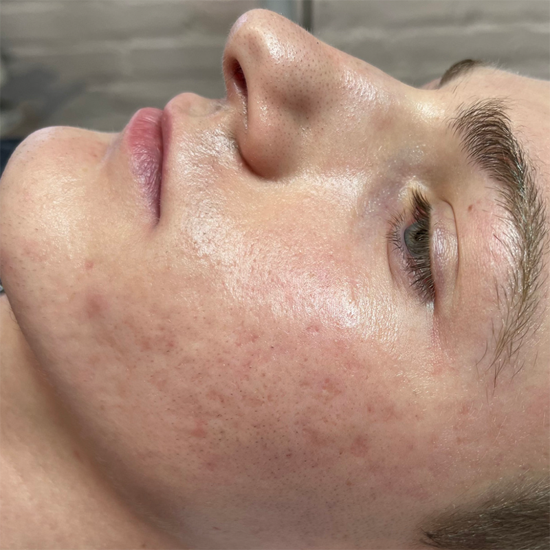 Microneedling Before & After Image