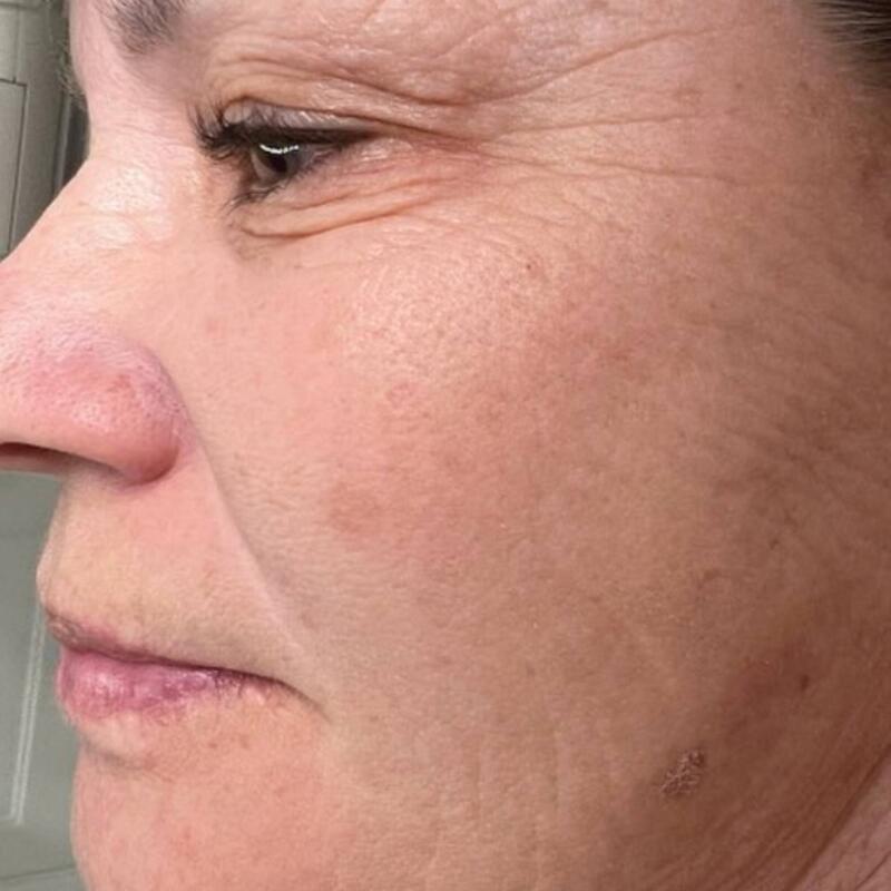 Photofacial IPL Before & After Image