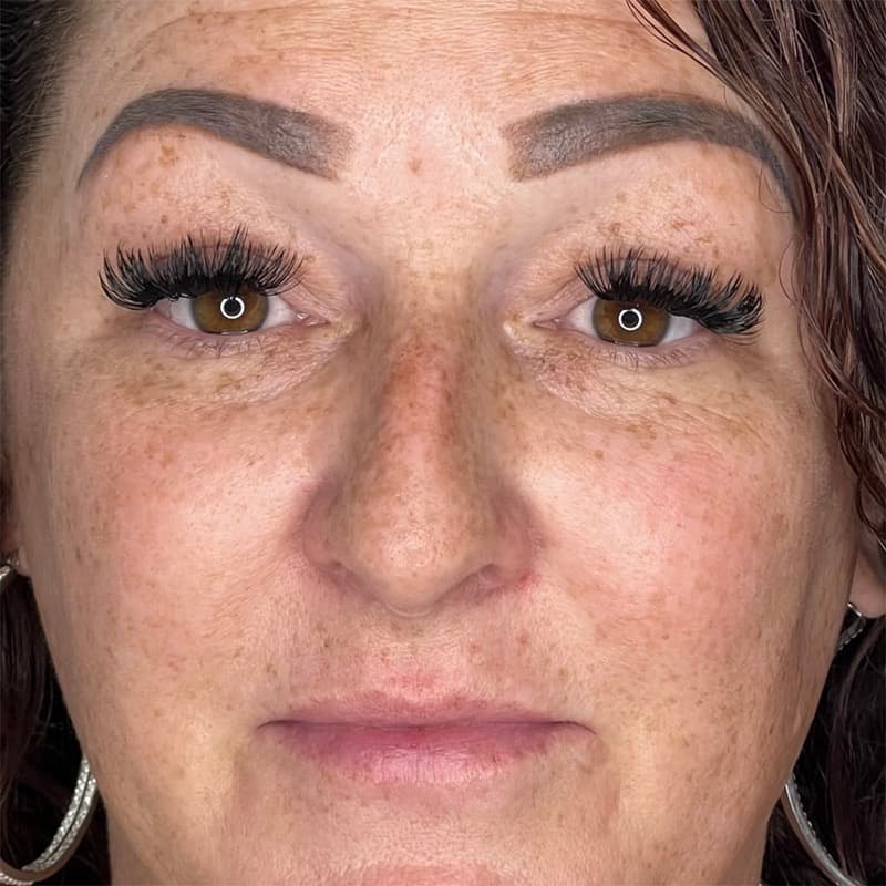 Photofacial IPL Before & After Image