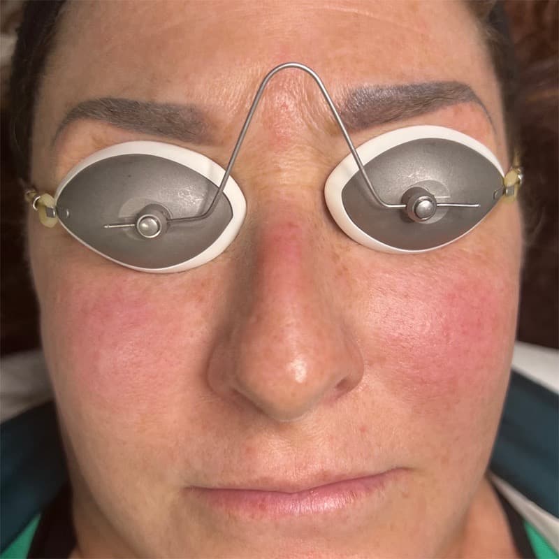 Photofacial IPL Before & After Image