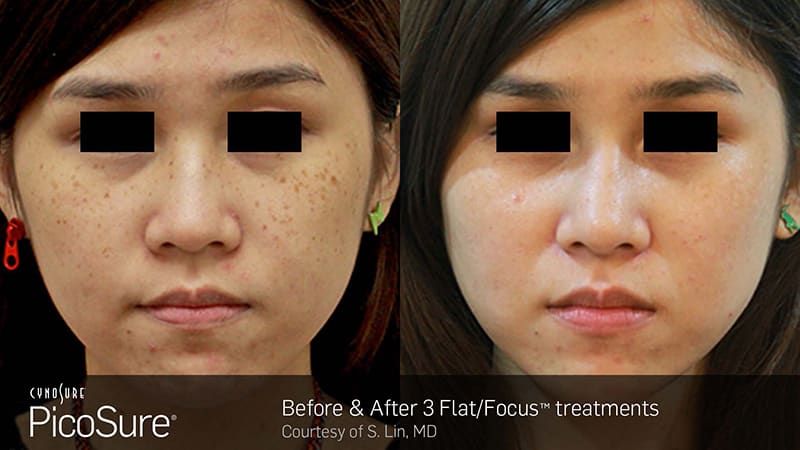 PicoSure Before & After Image