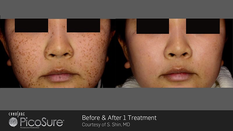 PicoSure Before & After Image