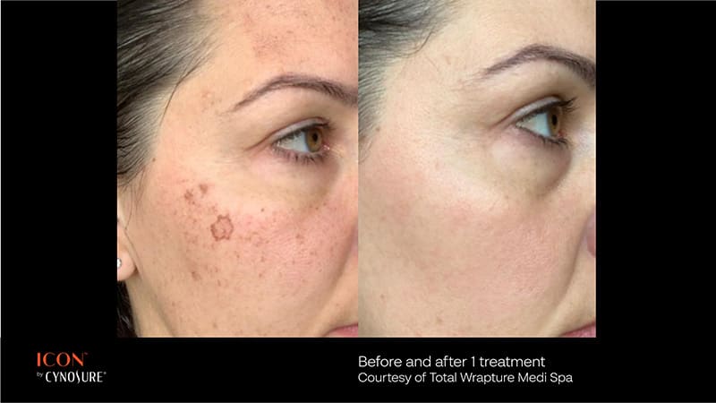 PicoSure Before & After Image