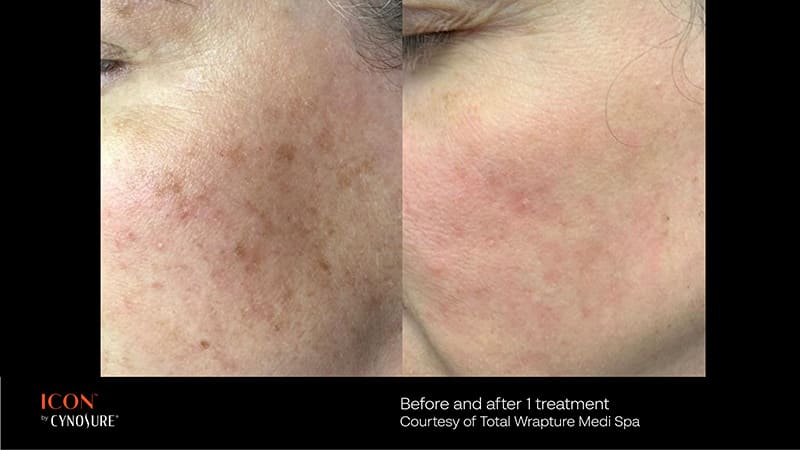 PicoSure Before & After Image