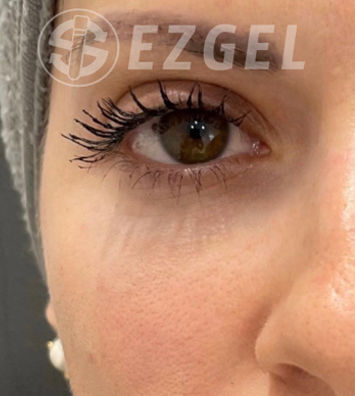 PRF ezGEL Before & After Image