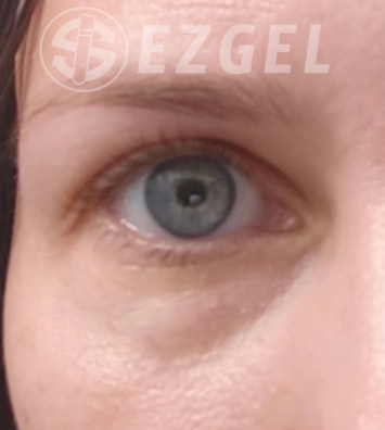 PRF ezGEL Before & After Image