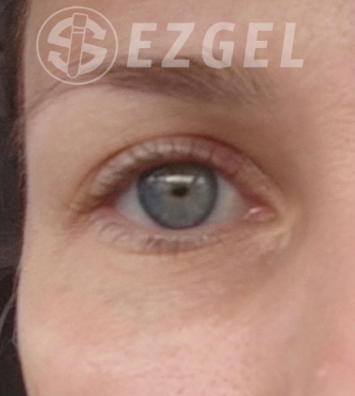 PRF ezGEL Before & After Image