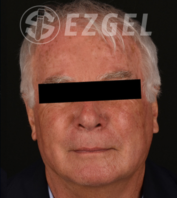 PRF ezGEL Before & After Image