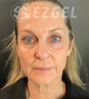 PRF ezGEL Before & After Image