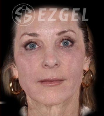 PRF ezGEL Before & After Image