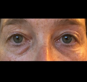 Under Eye Before & After Image