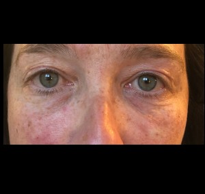 Under Eye Before & After Image